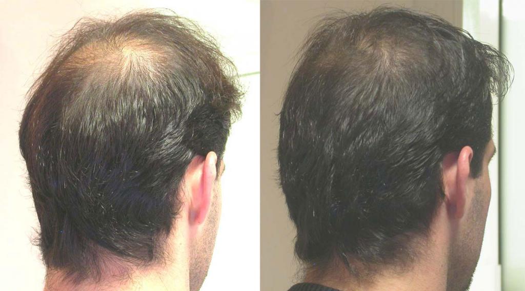 Отзывы о мезотерапии для волос