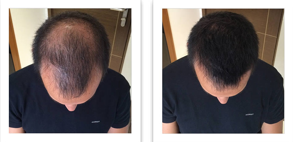 Лечение волос: до и после