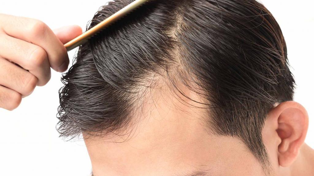 Как остановить выпадение волос у мужчин