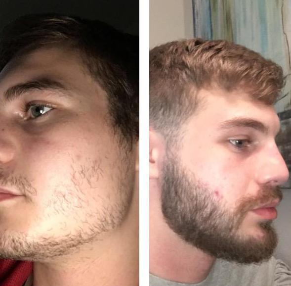Рост бороды после лечения
